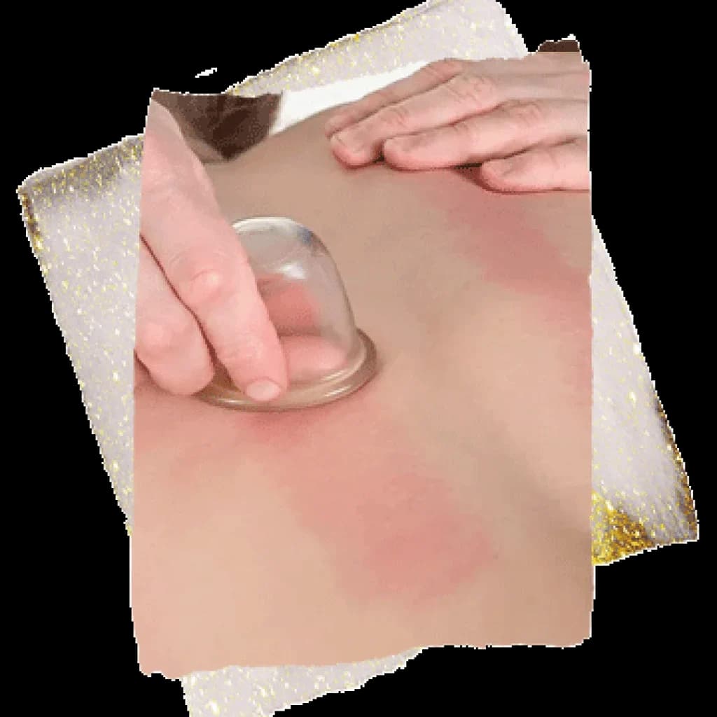 Hijama cupping therapy at 22 Ayur
