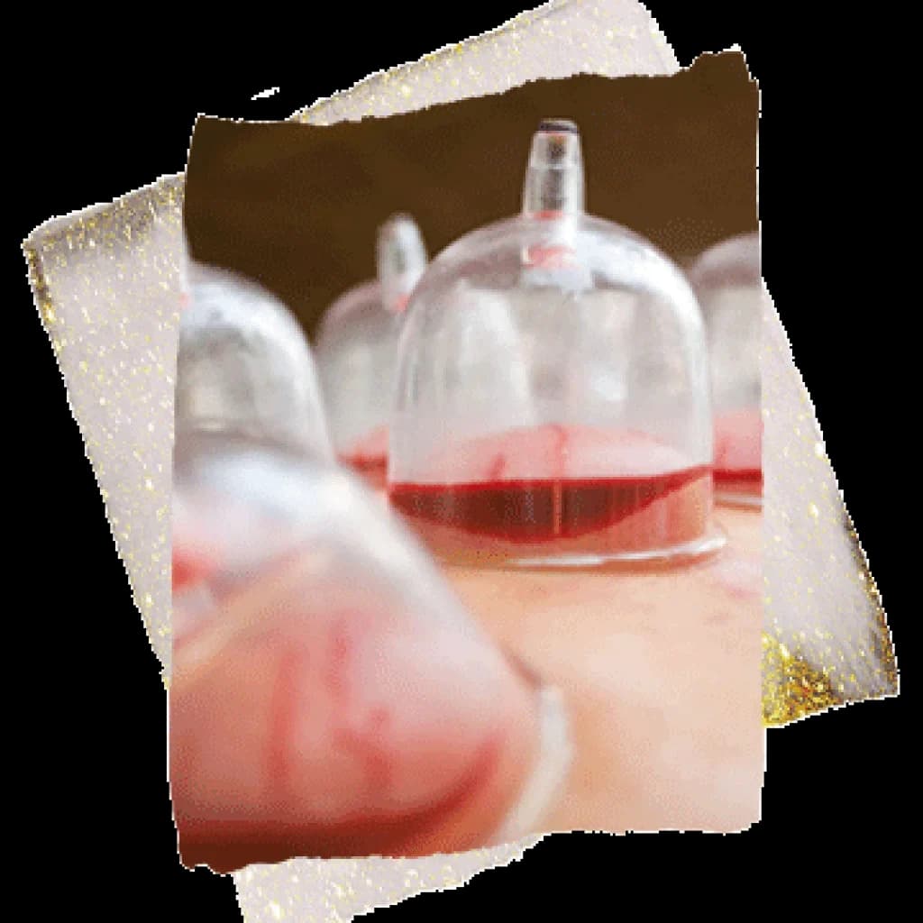 Hijama wet cupping therapy being performed at 22 Ayur